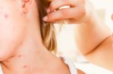 Nearly 40 million children are dangerously susceptible to growing measles threat Nearly 40 million children are dangerously susceptible to growing measles threat